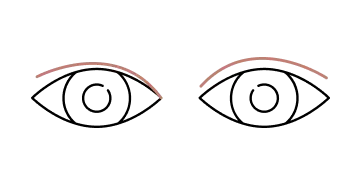 Asymmetrical Eyelids