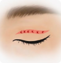 Incisional Technique