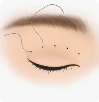 Scarless (Suture) Technique
