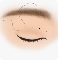 Scarless (Suture) Technique